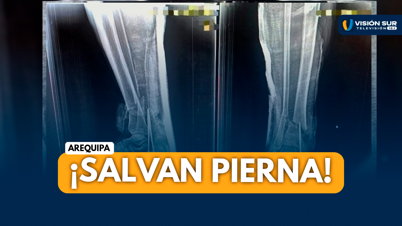 AREQUIPA: HOSPITAL HONORIO DELGADO SALVA PIERNA DE PACIENTE TRAS GRAVE ACCIDENTE CON SIERRA ELÉCTRICA