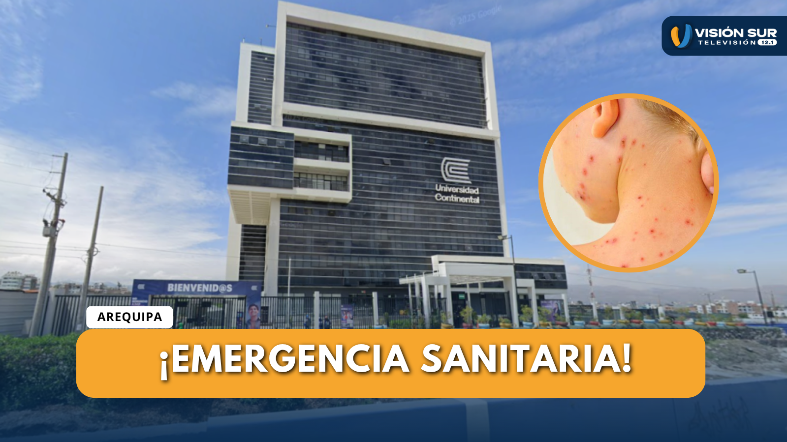 AREQUIPA REPORTA SEGUNDO CASO IMPORTADO DE SARAMPIÓN PROCEDENTE DE PUNO